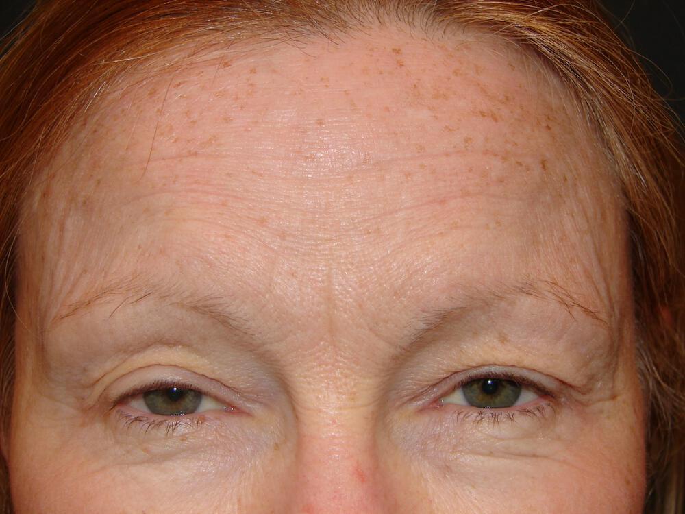 Brow Lift Before & After Image