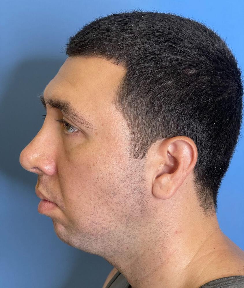Male Facial Plastic Surgery Before & After Image