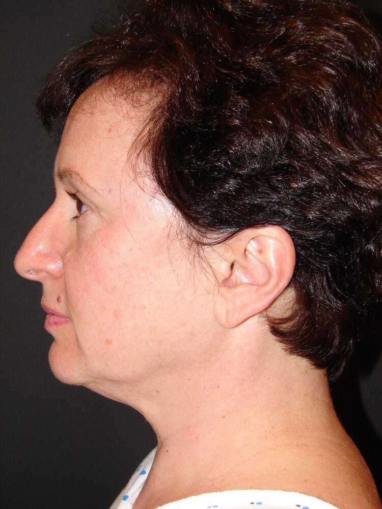 Mini Facelift Before & After Image