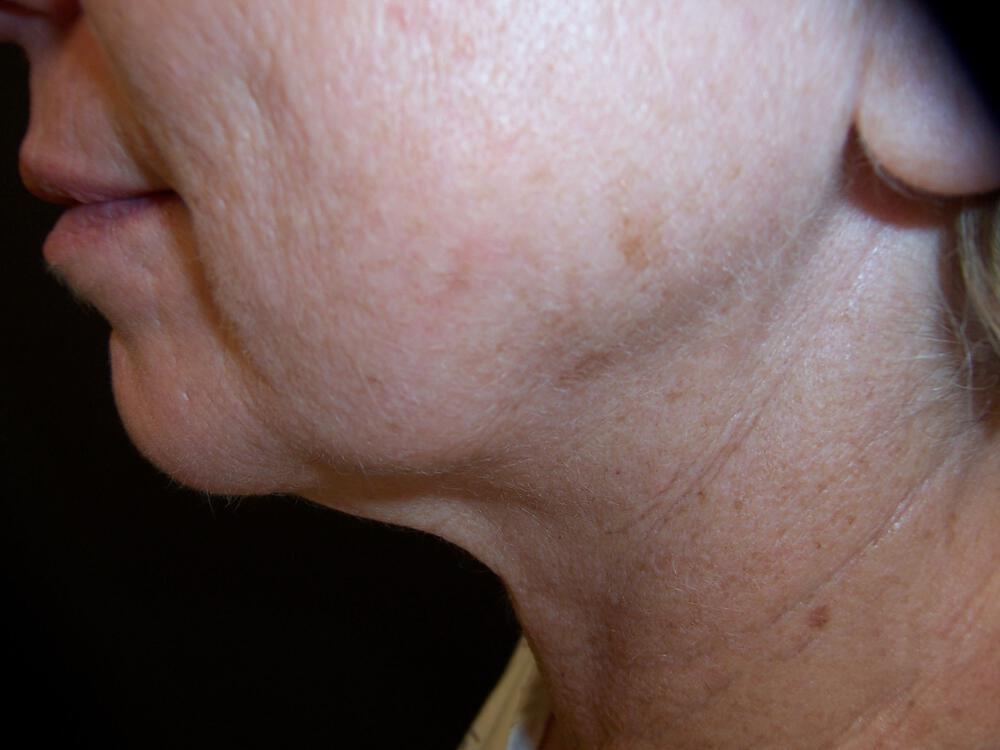 Chin Implants Before & After Image