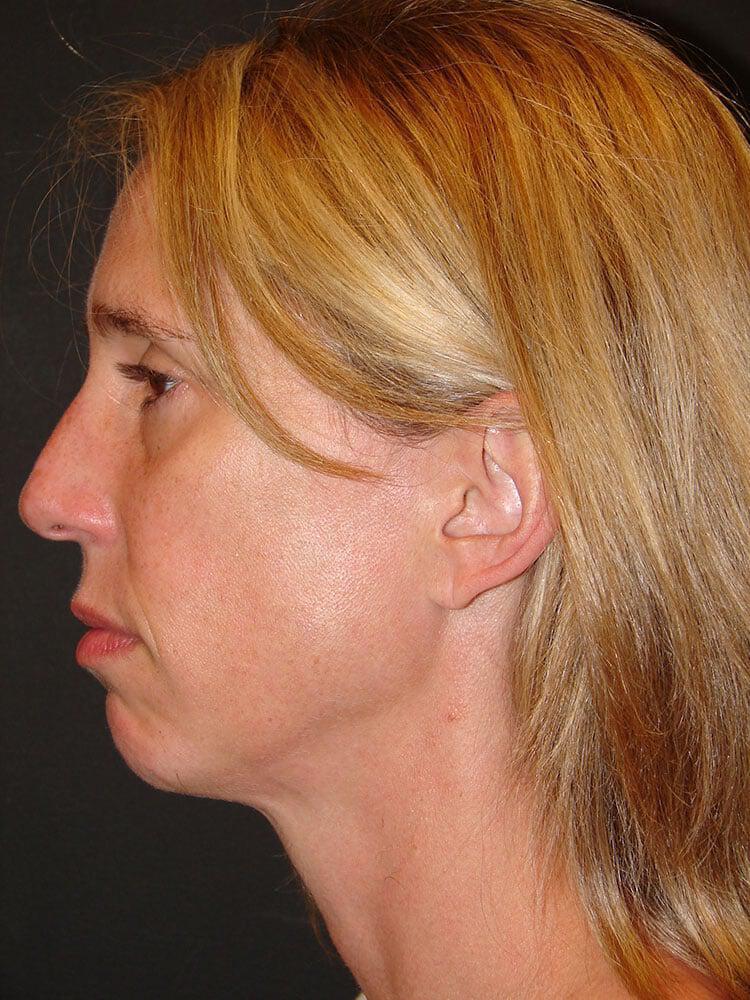 Chin Implants Before & After Image