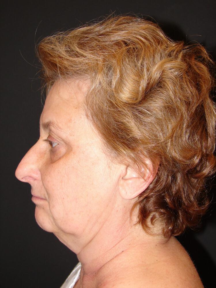 Chemical Peels Before & After Image
